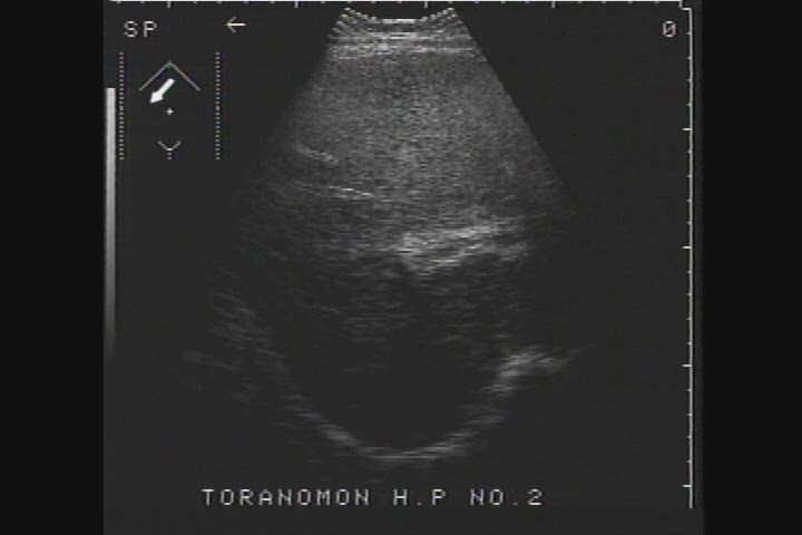 肝アミロイドーシス：日経メディカル