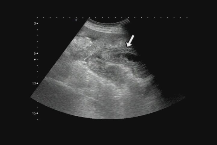 GVHDによる腸炎：日経メディカル