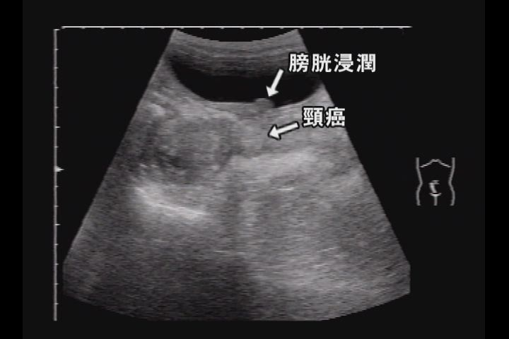 子宮癌 日経メディカル