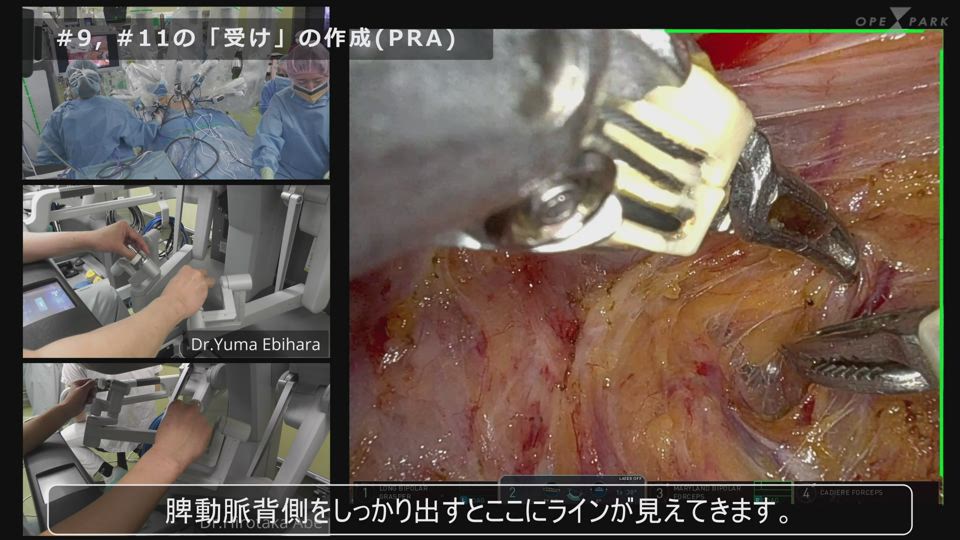 デュアルコンソール指導！ 3分で学ぶ、ロボット支援幽門側胃切除