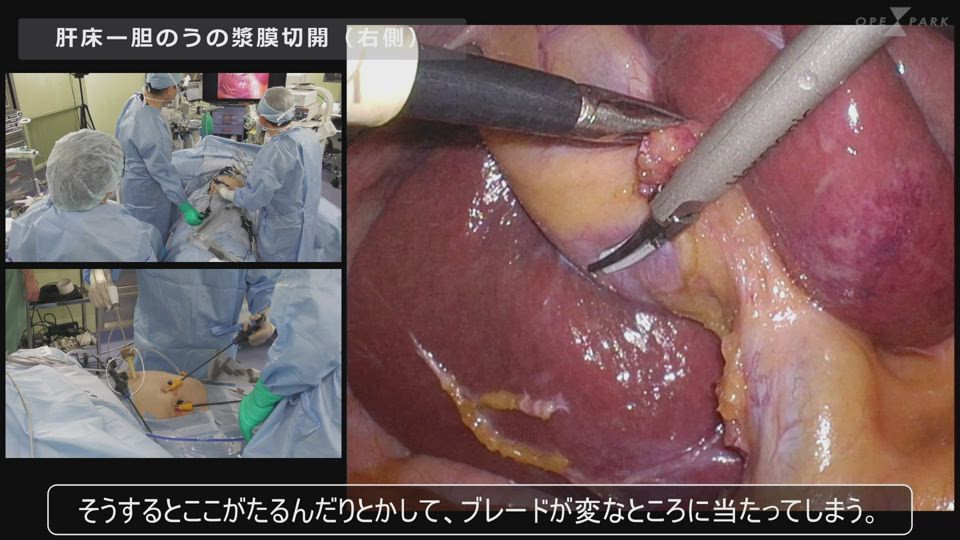 大流行中！ 動画でわかる腹腔鏡下胆嚢摘出術: 基本から技術認定